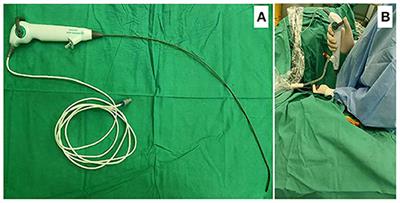 Single-Use vs. Reusable Digital Flexible Ureteroscope to Treat Upper Urinary Calculi: A Propensity-Score Matching Analysis